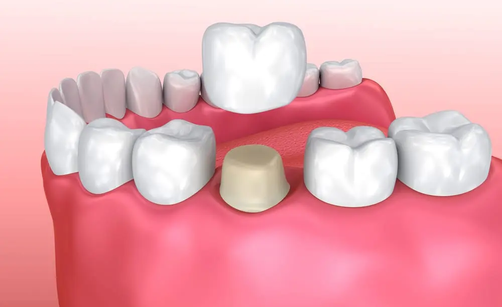 Răng cần mài nhỏ trước khi bọc