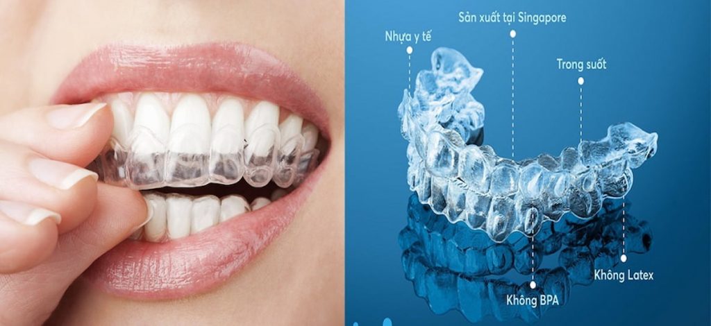 Niềng răng trong suốt mang tính thẩm mỹ cao và thời gian niềng răng được rút ngắn.