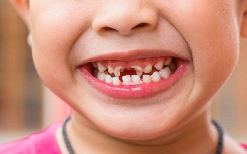 Giai đoạn đầu rất khó nhận biết, thông thường phụ huynh phát hiện răng sữa của trẻ bị ăn mòn khi đã bị tổn hại nhiều