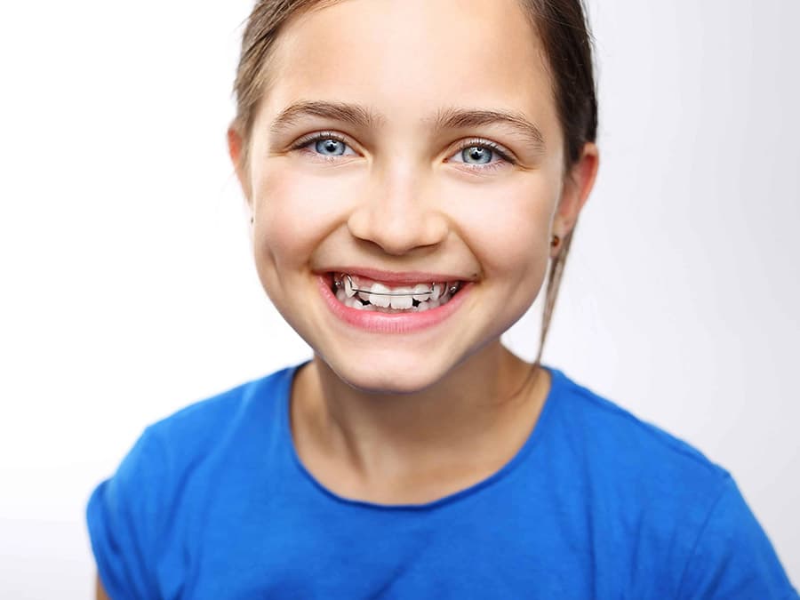 Niềng răng khểnh là phương pháp sử dụng lực kéo từ các khí cụ chỉnh nha để dịch chuyển răng khểnh mọc lệch, sai vị trí về đúng vị trí mong muốn