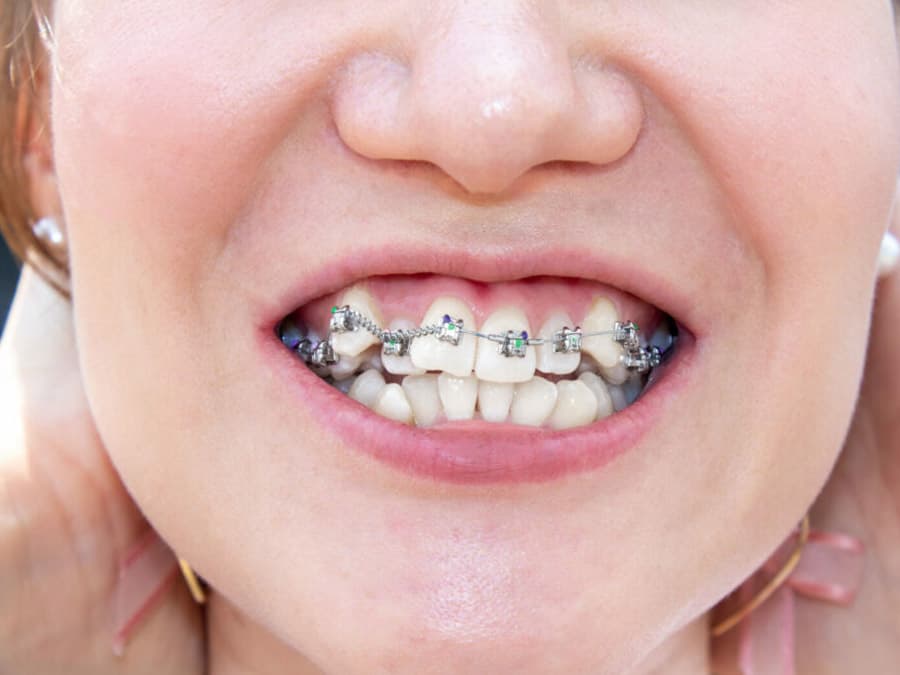 Niềng răng khểnh sẽ dao động trong khoảng 18 – 24 tháng, trường hợp răng phức tạp thì mất tới 36 tháng.