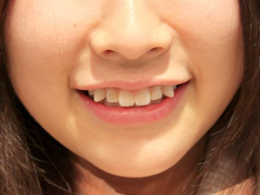 Răng khểnh đẹp hay xấu tùy vào cấu trúc răng, mức độ lệch của răng và khuôn mặt của từng người