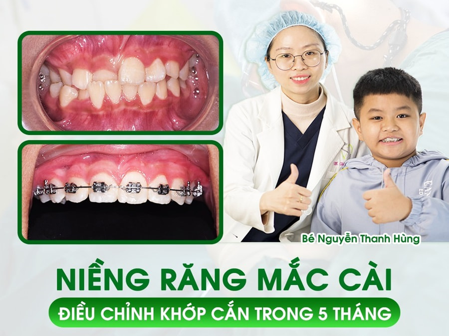 Niềng răng mắc cài cố định bao nhiêu tiền?