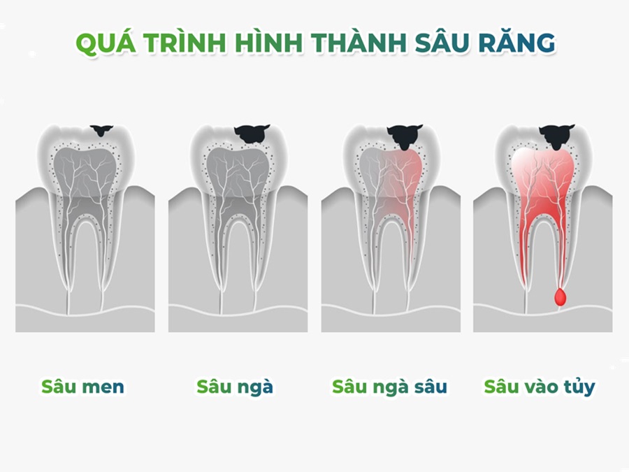 Xác định mức độ răng bị thủng lỗ để có cách điều trị